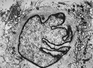 F, 49y. | myelosarcoma … histiocyte-like cells in dermal infiltrates